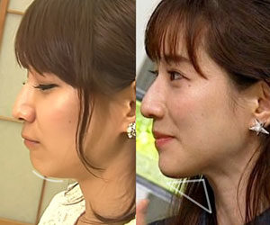 Tanaka Minami, chin, profile, changed, plastic surgery suspicion