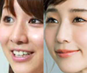 Tanaka Minami, nose, changed, comparison